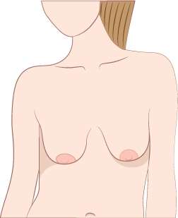 Saggy Breasts